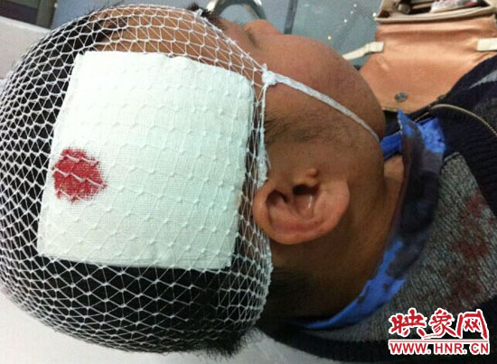 頭部傷口 頭部傷口