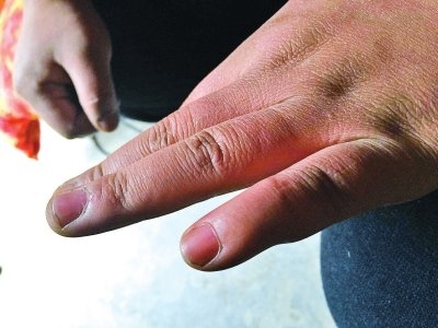 哥為給弟看病無錢支付彩禮 夫妻吵架自殘剁手指 哥為給弟看病無錢支付彩禮 夫妻吵架自殘剁手指