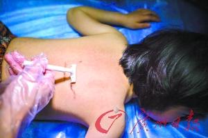 9歲女童得怪病 因服用廉價激素藥物致全身長毛 9歲女童得怪病 因服用廉價激素藥物致全身長毛