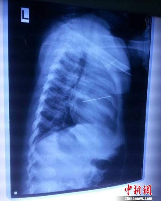 河南心臟被扎針女嬰術(shù)后尚未脫險家人渴求真相 河南心臟被扎針女嬰術(shù)后尚未脫險家人渴求真相