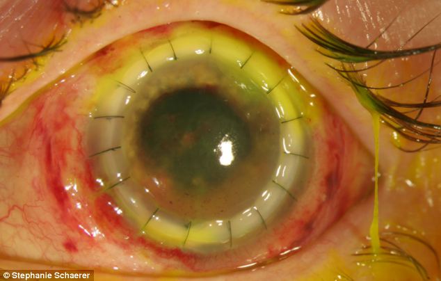 恐怖慎入！隱形眼鏡致英女子摘除眼球