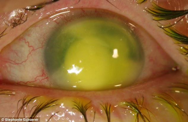 恐怖慎入！隱形眼鏡致英女子摘除眼球