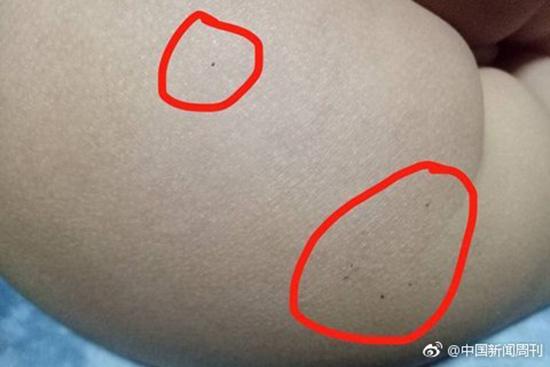 據多名紅黃藍(新天地分園)家長反映，孩子腿部、屁股、腋下出現針眼。
