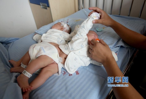 一對連體女嬰成功分離 一對連體女嬰成功分離