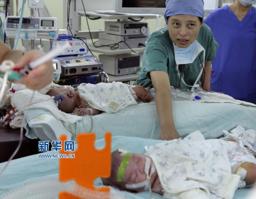 一對連體女嬰成功分離 一對連體女嬰成功分離