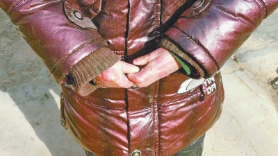 長期受損的手指,已經長在了一起。 長期受損的手指,已經長在了一起。