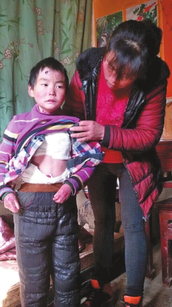 受損的皮膚纏著衛生紙 受損的皮膚纏著衛生紙