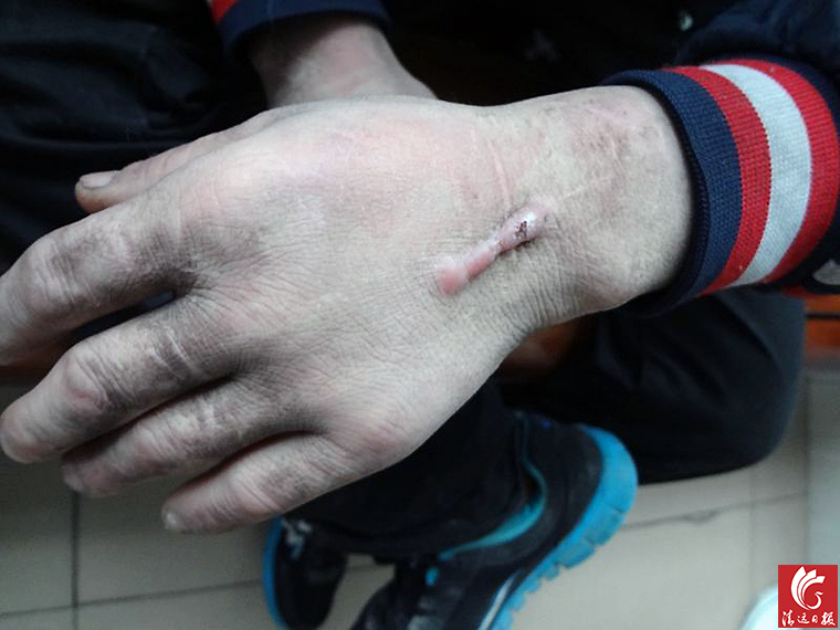 被發現男子手上的傷疤。