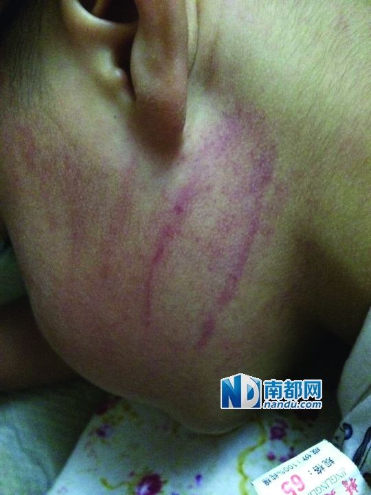 小逸臉上淤痕清晰可見。 小逸臉上淤痕清晰可見。
