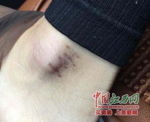 南昌一酒店玻璃門爆裂顧客多處割傷 店方拒賠償 南昌一酒店玻璃門爆裂顧客多處割傷 店方拒賠償