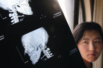 國內醫院CT顯示,如今靳魏坤的鼻子假體是歪的,連下巴也是歪的 國內醫院CT顯示,如今靳魏坤的鼻子假體是歪的,連下巴也是歪的